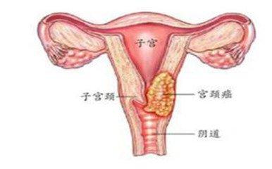 肛周疣研究最新动态及医疗技术治疗进展摘要总结报告